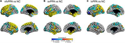 Cortical neuroanatomical changes related to specific language impairments in primary progressive aphasia
